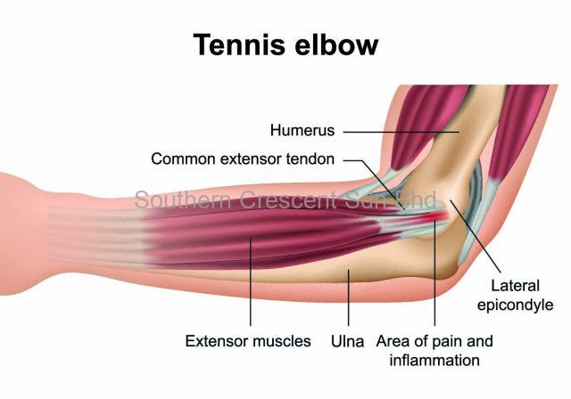 Tenis Elbow